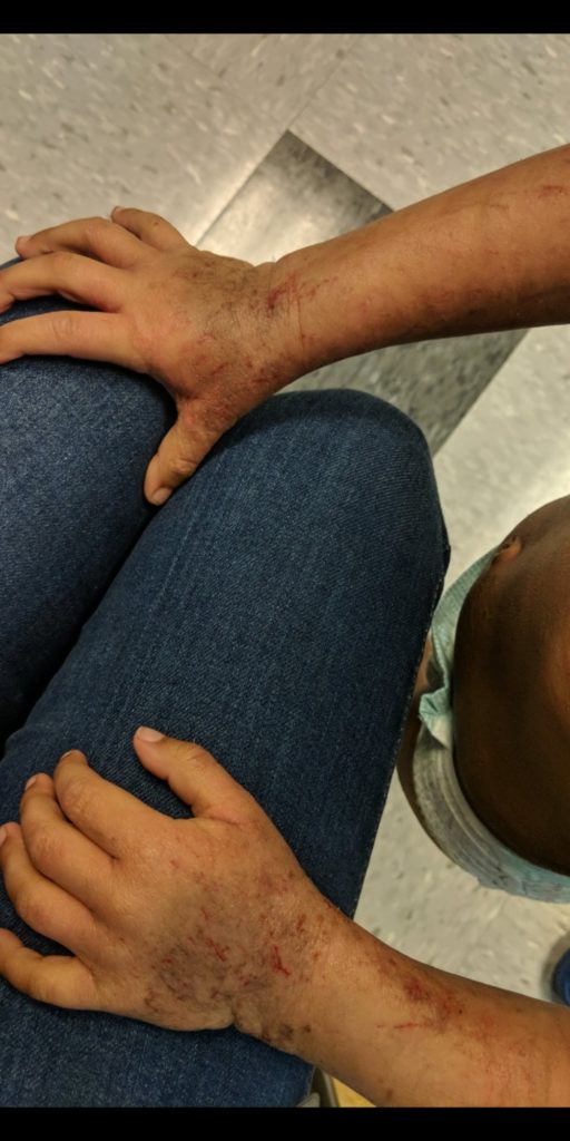 photo of severe childhood eczema before functional nutrition