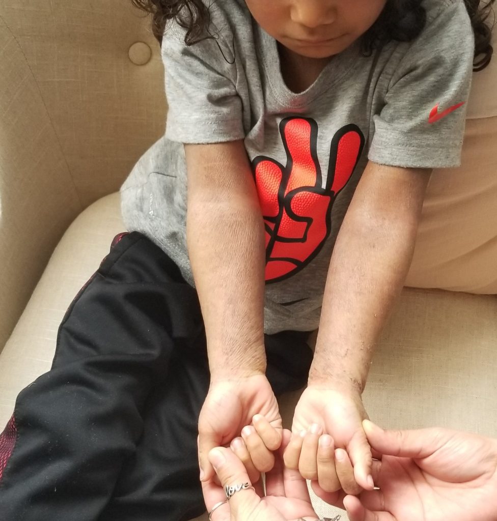 photo of one month of functional nutrition progress for eczema in child